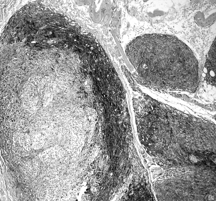 Infiltrating giant cellular blue naevus | Journal of Clinical Pathology