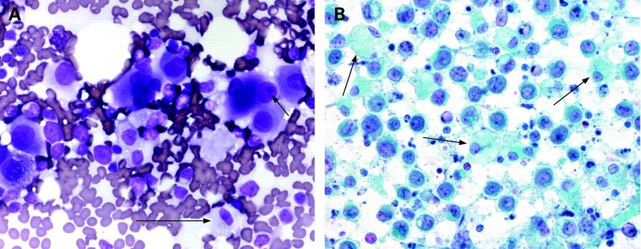 Cytological Features Of Melanoma In Exfoliative Fluid Specimens Cytological Features Of Melanoma In Exfoliative Fluid Specimens
