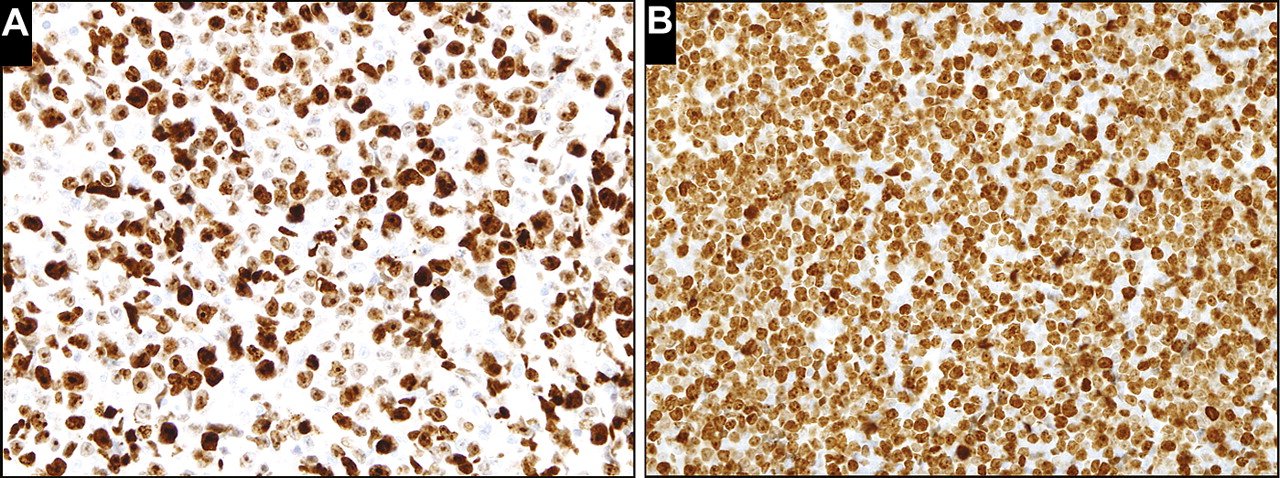 Composite diffuse large B-cell lymphoma and precursor B lymphoblastic ...