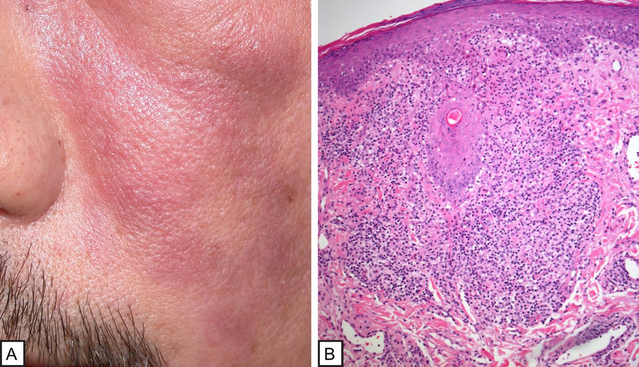 Granulomatous Rosacea Histology Granulomatous Rosacea Histology