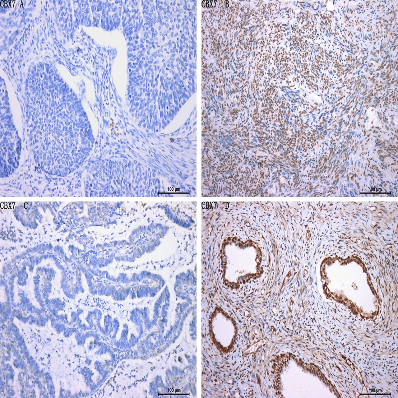 Expression and correlation analysis of Skp2 and CBX7 in cervical cancer ...