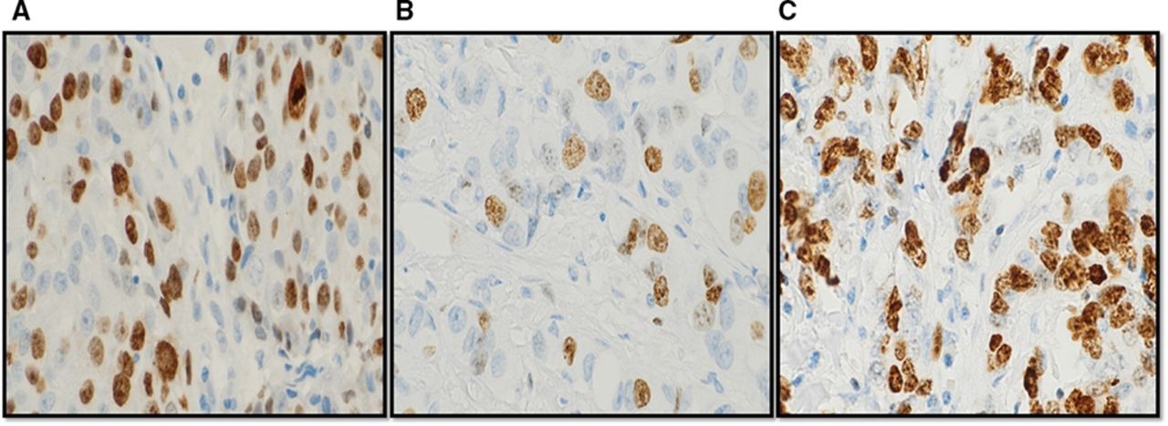 Expression, assessment and significance of Ki67 expression in breast ...